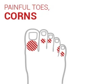 corns on foot