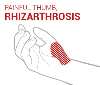 Basal thumb arthritis