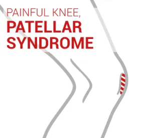 Patellofemoral pain syndrome