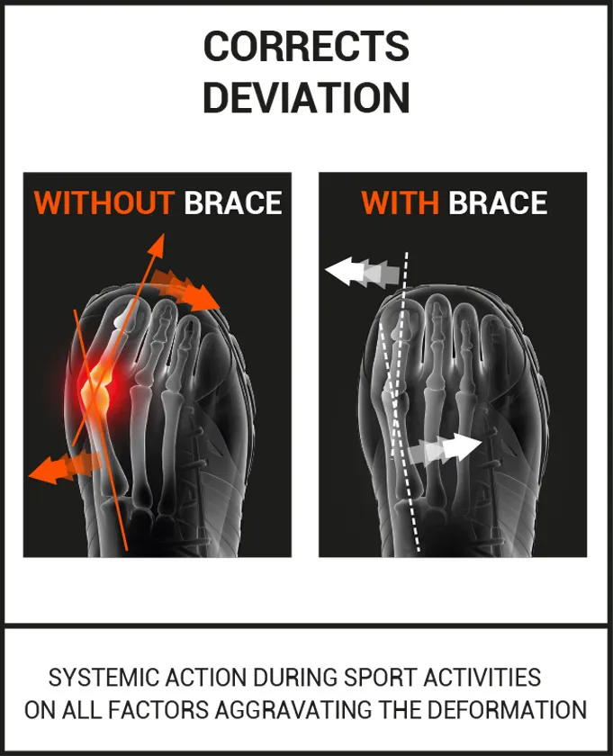 Flexible bunion brace sport